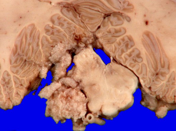 3B5 Meningioma (Case 3) gross 1_4