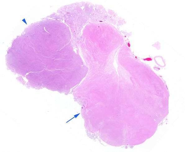 3C1 Meningioma (Case 3) N8 copy