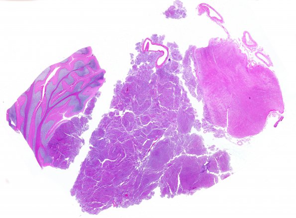 3D1 Meningioma (Case 3) N13 H&E