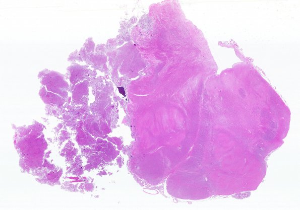 3D2 Meningioma (Case 3) N14