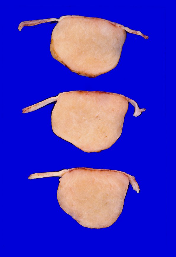 41A2 Meningioma (Case 41) 2