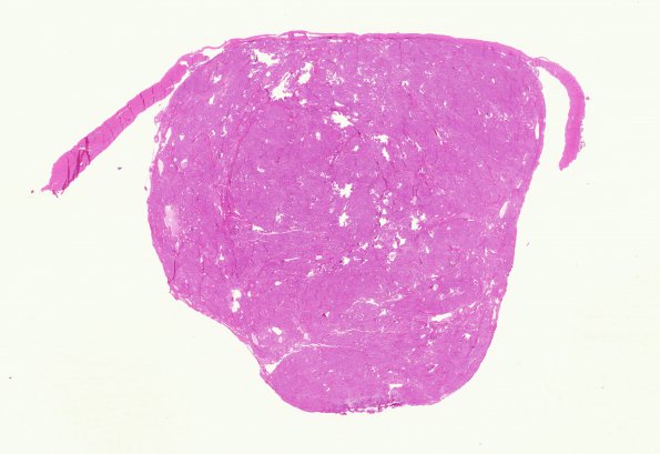 41B Meningioma (Case 41) H&E whole mount