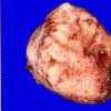 42A1 Meningioma (Case 42) Gross _1