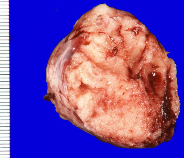 42A1 Meningioma (Case 42) Gross _1