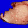 42A2 Meningioma (Case 42) Gross _2