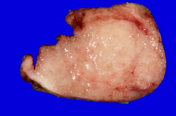 42A2 Meningioma (Case 42) Gross _2