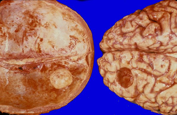 44A Meningioma (Case 44) 1