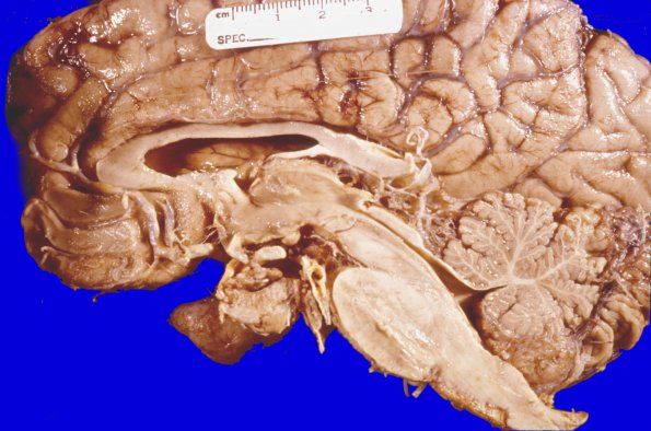 45A Meningioma (Case 45)