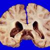 46A Meningioma (Case 46)