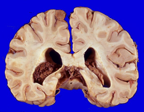 46A Meningioma (Case 46)