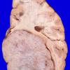 47A Meningioma (Case 47) intraventricular