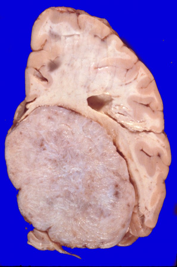 47A Meningioma (Case 47) intraventricular