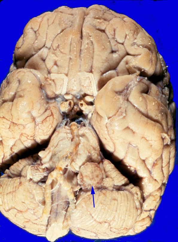 49A Meningioma (Case 49) 1 copy