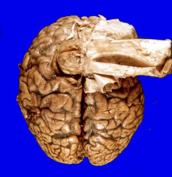 4A1 Meningioma (Case 4)