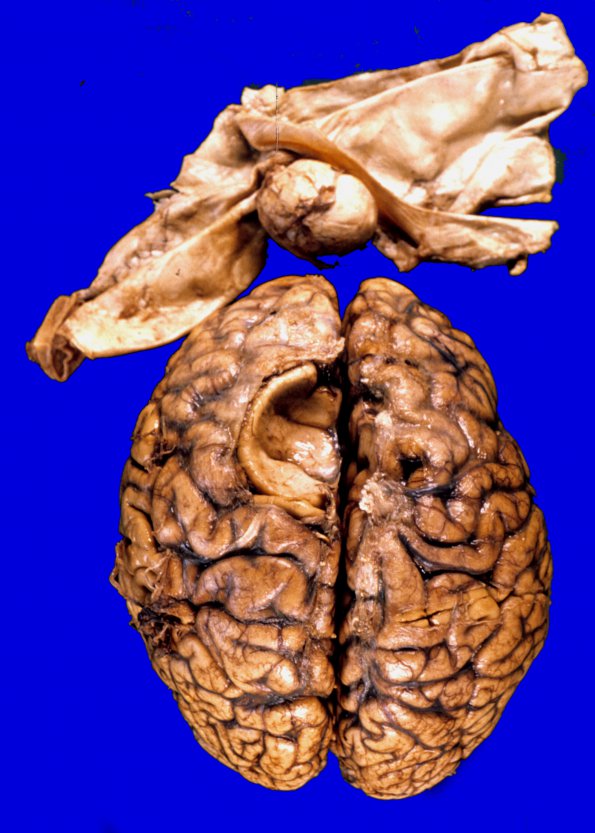 4A2 Meningioma (Case 4) 2