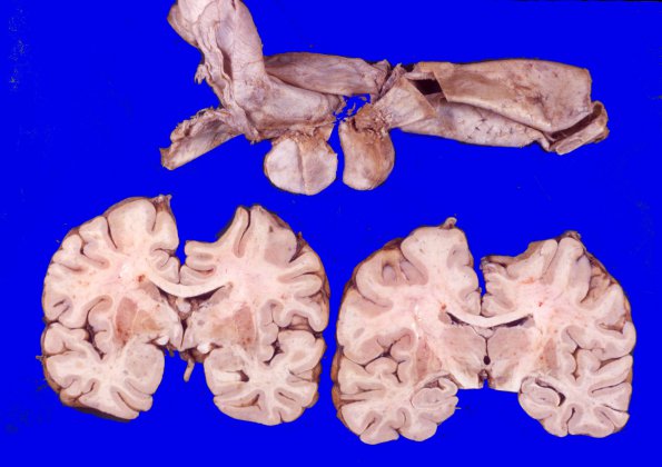 4A3 Meningioma (Case 4) 4