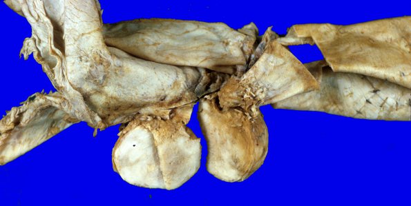 4A5 Meningioma (Case 4) gross