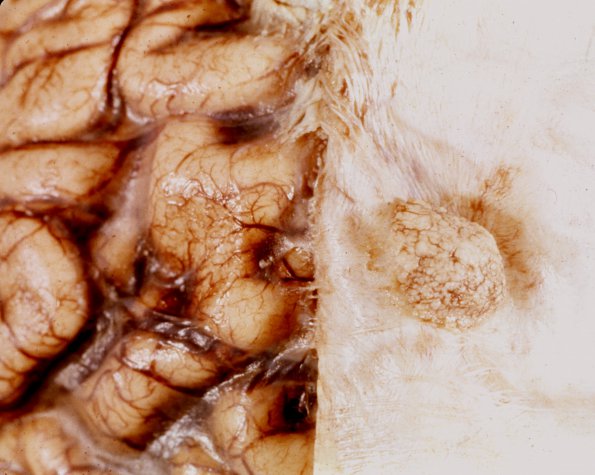 50A Meningioma (Case 50)