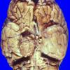 51A1 meningioma, parasellar (Case 51)