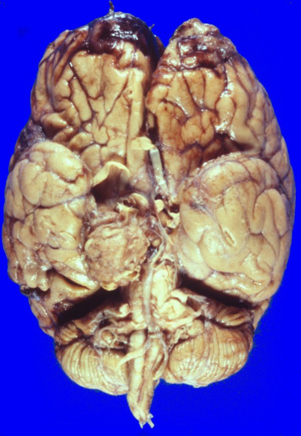 51A1 meningioma, parasellar (Case 51)