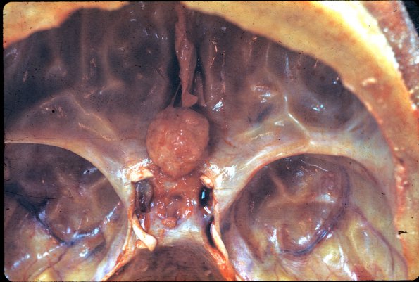 52 Meningioma (Case 52)