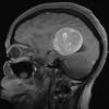 53A1 Meningioma, intraventricular (Case 53) T1 W 3