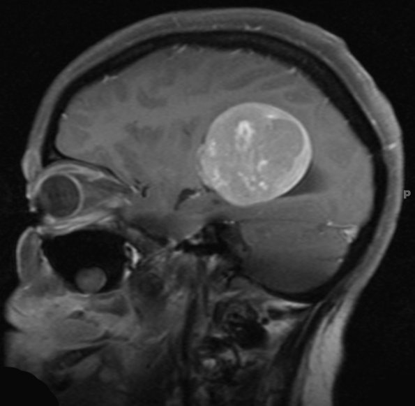 53A1 Meningioma, intraventricular (Case 53) T1 W 3