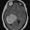 53A2 Meningioma, intraventricular (Case 53) T1 W 4