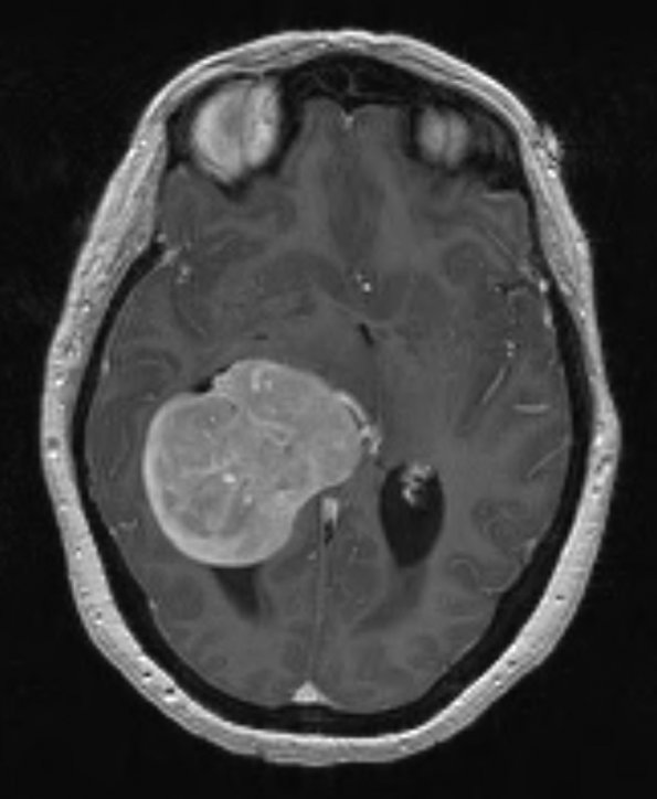 53A2 Meningioma, intraventricular (Case 53) T1 W 4