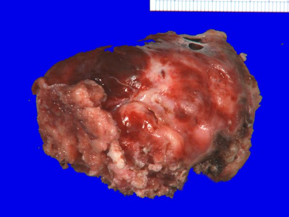 53B Meningioma, intraventricular (Case 53) Gross_2