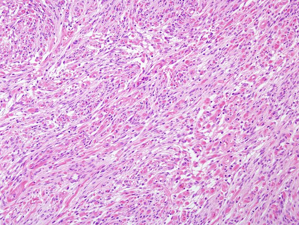 53C1 Meningioma, intraventricular (Case 53) H&E 3