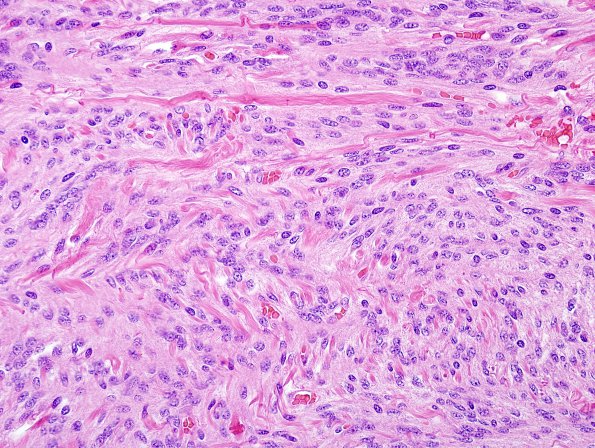 53C2 Meningioma, intraventricular (Case 53) H&E 5