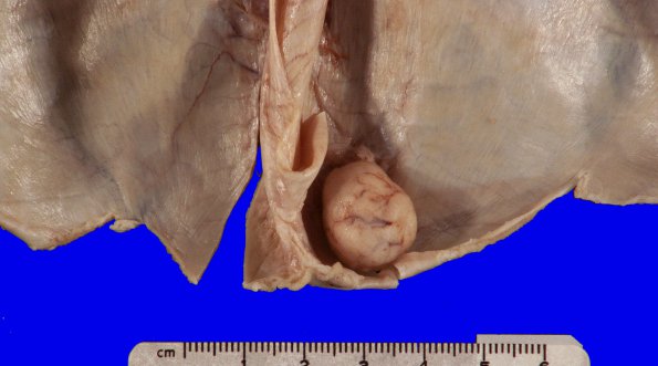 55A Meningioma, incidental (Case 55) Gross