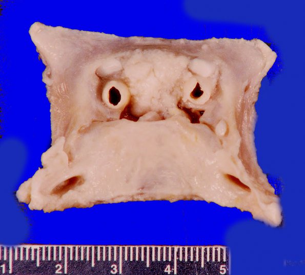 58A1 Meningioma, incidental (Case 58) 1