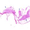 58B1 Meningioma, incidental (Case 58) WM H&E copy