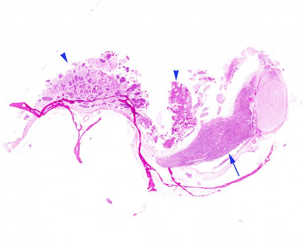 58B1 Meningioma, incidental (Case 58) WM H&E copy