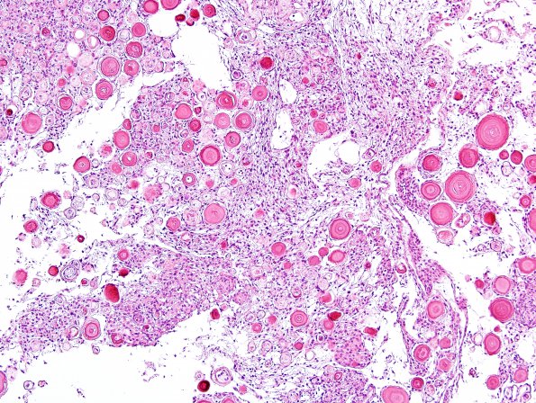 58B2 Meningioma, incidental (Case 58) H&E 1