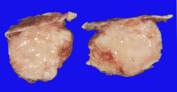 59A Meningioma (Case 59) 1