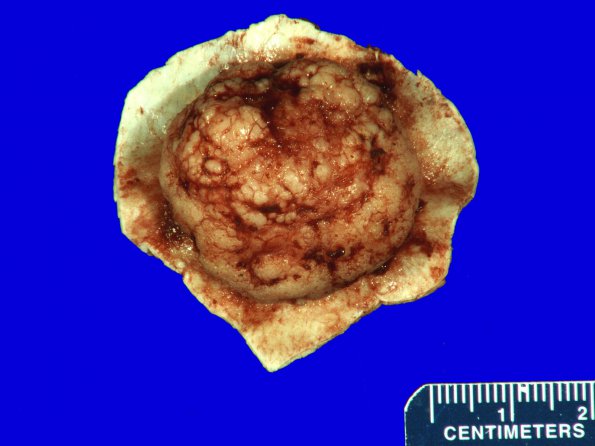 60A1 Meningioma (Case 60) Gross _1