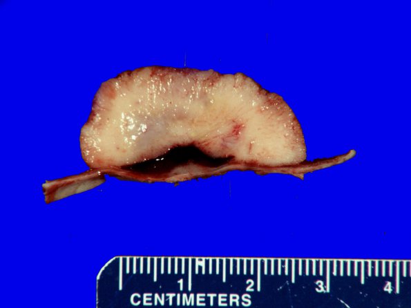 60A2 Meningioma (Case 60) Gross _2