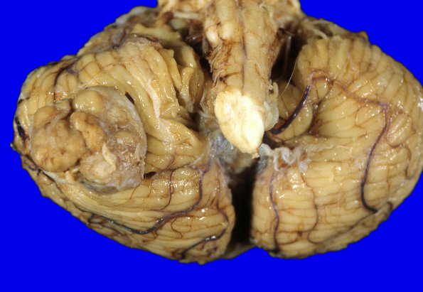 61A1 Meningioma, cerebellum (Case 61) 2