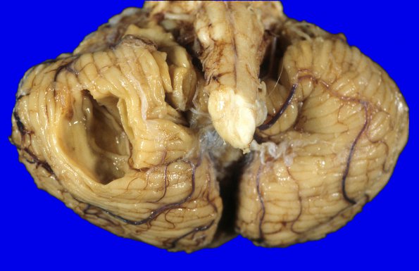 61A3 Meningioma, cerebellum (Case 61) 4