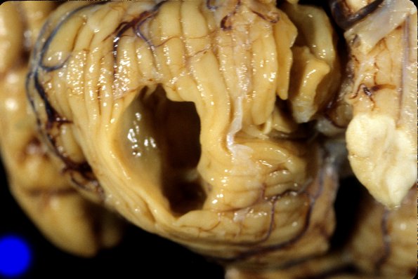 61A4 Meningioma, cerebellum (Case 61) 3