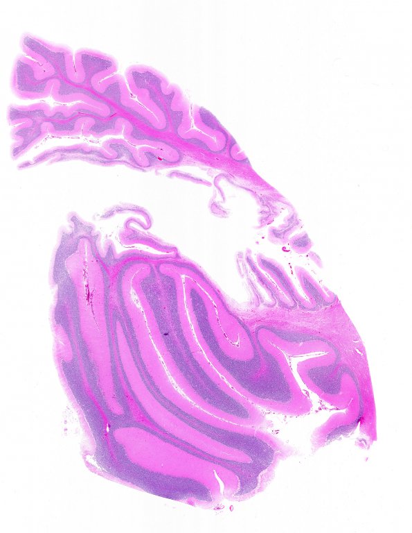 61B1 Meningioma, cerebellum (Case 61) 5