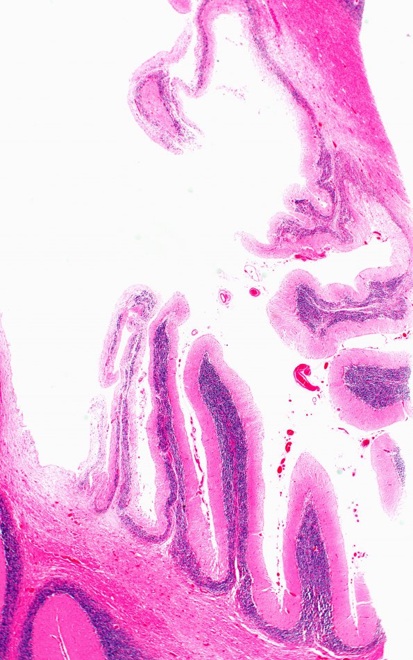 61B2 Meningioma, cerebellum (Case 61) N10B 2X A