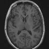 62A1 Meningioma (Case 62) T1 no C - Copy