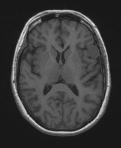 62A1 Meningioma (Case 62) T1 no C - Copy