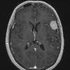 62A2 Meningioma (Case 62) T1W - Copy