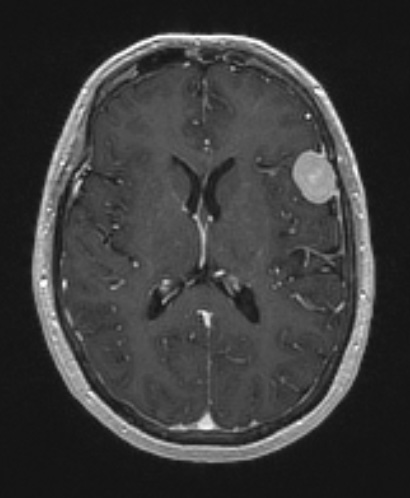 62A2 Meningioma (Case 62) T1W - Copy