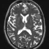 62A3 Meningioma (Case 61) T2 - Copy